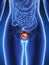 Bladder cancer