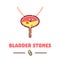 Bladder stones cartoon poster