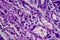 Bladder transitional cell carcinoma, light micrograph