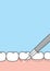 Blank banner Gingivoplasty & Gingivectomy electrosurgery cut gum off illustration vector on blue background. Dental concept