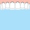 Blank banner Upper Essix retainer illustration vector on blue background. Dental concept