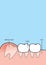 Blank banner wisdom Impacted tooth inside under inflammation gum illustration vector on blue background. Dental concept