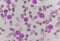 Blast cells in Leukemia