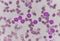 Blast cells in Leukemia