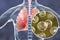 Blastomyces dermatitidis infection of lungs