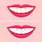 Bleaching teeth treatment. Whiten teeth before and after.