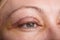 Blepharoplasty of the upper eyelid.