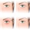 blepharoplasty, upper eyelid plastic, before and after images