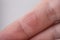 Blister on Human Finger. Selected focus