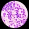 Blood cancer. Acute Myeloblastic Leukemia or AML.