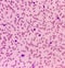 Blood cancer. Acute Myeloblastic Leukemia or AML