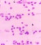 Blood cancer. Acute Myeloblastic Leukemia or AML