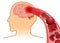 Blood cell can`t flow into human brain because clogged arteries by blood clot.