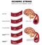 Blood clot formation in the cerebral artery