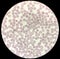 Blood film microscopic show decrease platelets leucocyte (WBC).