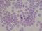 Blood parasite infected red blood cells Malaria