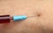 Blood sampling with syringe and needle