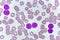 Blood smear of chronic lymphocytic leukemia
