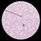 Blood smear Malaria parasite positive