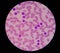 Blood smear showing chronic lymphoblastic leukemia (CLL)