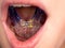 Blue dental braces in chuldren mouth