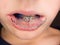 Blue dental braces in chuldren mouth