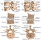 BOARD Advanced uncovertebral arthrosis