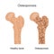 Bone Osteoporosis Illustration