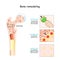 Bone remodeling process. Osteoblast, osteoclast, and osteocyte