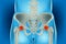 Bones of the pelvis and hip, human anatomy, femur bone joint pain, X ray of the hip joint and femur. Osteonecrosis of