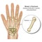 Boxer`s bone hand fracture medical vector illustration