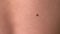 Boy's white skin in back with big brown mole before laser removing, closeup.