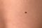 Boy& x27;s white skin in back with big brown mole before laser removing, closeup.