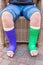 Boy sits with two colored gypsum legs