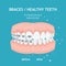 Braces concept. White spots. Stomatology dentistry vector