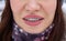 Braces on the girl`s teeth, macro photo teeth, close-up lips,