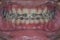 Braces in male teeth