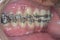 Braces in male teeth