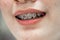 Braces in teenage girl mouth to treat and beauty for increase confidence and good personality