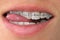 Bracket system in smiling mouth, macro photo teeth, close-up lips