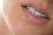 Bracket system in smiling mouth, macro photo teeth, close-up lips