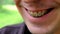 Brackets for yellowed teeth. Close-up of a smiling guy. The teeth of a smoking person. Shallow depth of field. Dental