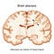 Brain abscess. Cerebral abscess. Cross section of a human brain with intracerebral collection of pus