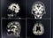 Brain atrophy for education and diagnostic