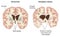 Brain atrophy in Huntingtons disease