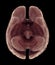 Brain Atrophy Or Severe Shrinkage Of The Brain Caused By Dementia And Alzheimer