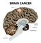 Brain cancer