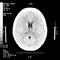 Brain CT Scan