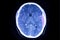 Brain CT scan, epidural hemorrhage