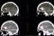 Brain CT scan, intracerebral hemorrhage